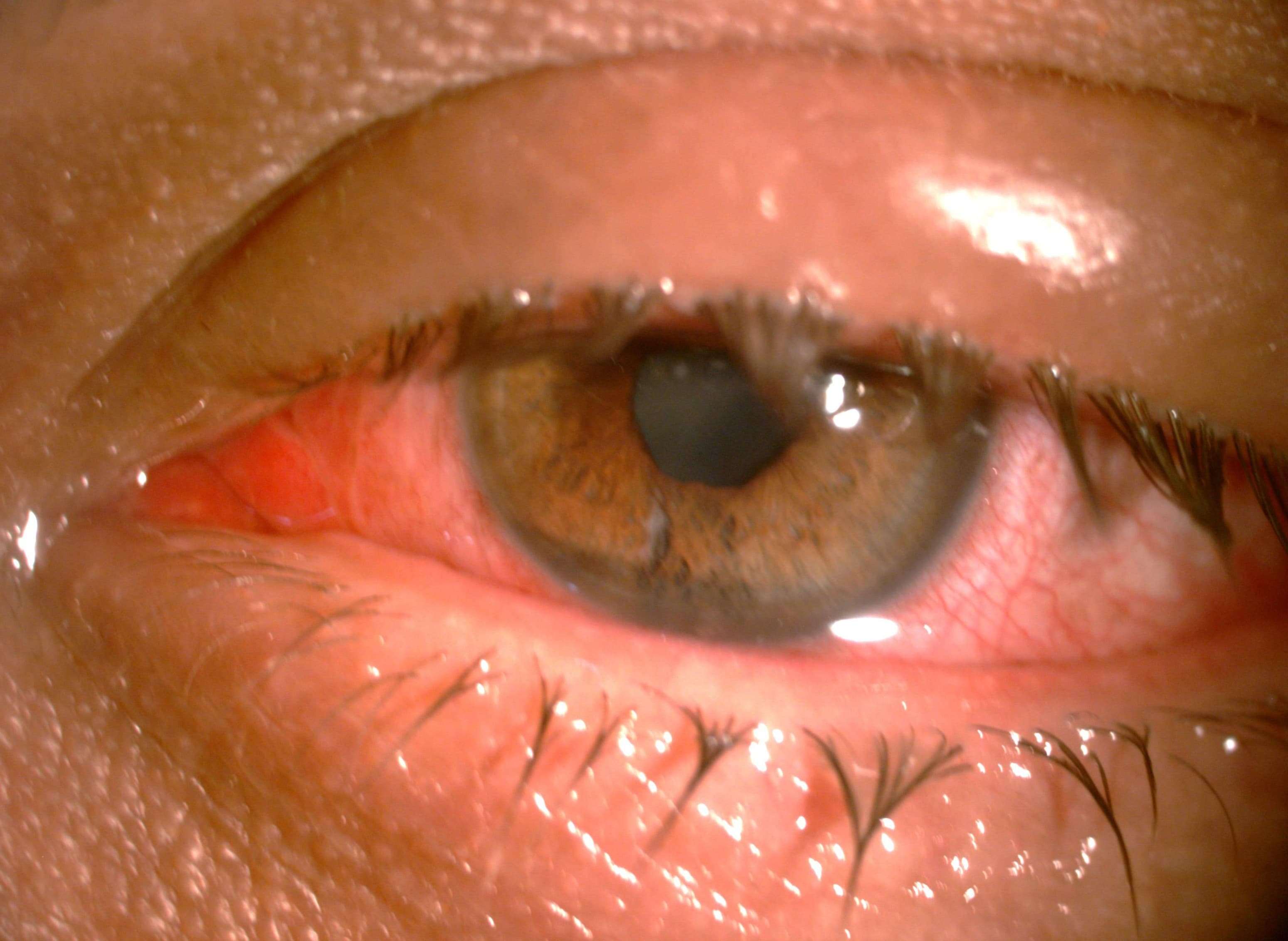 Acute Conjunctivitis