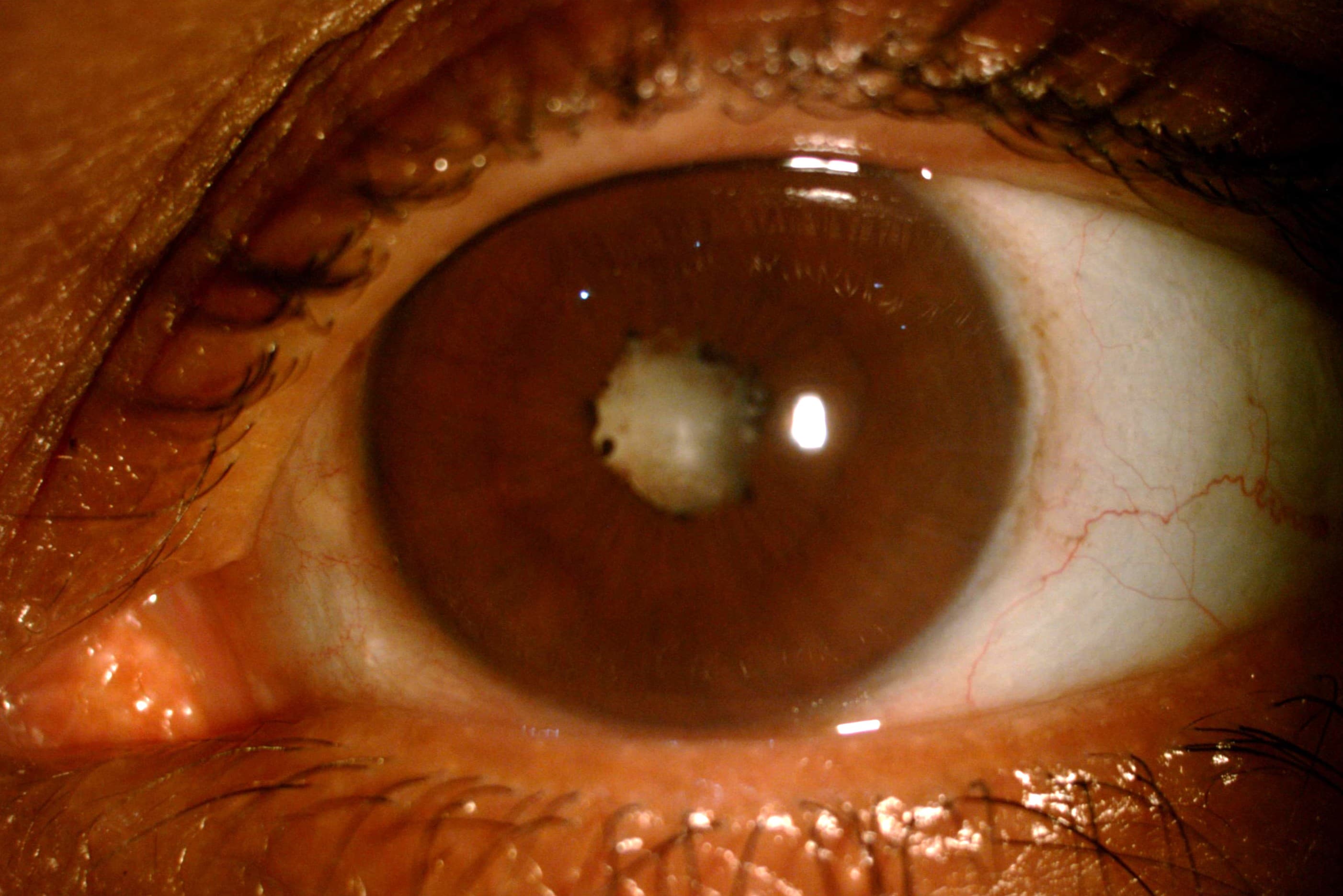 Complicated Cataract