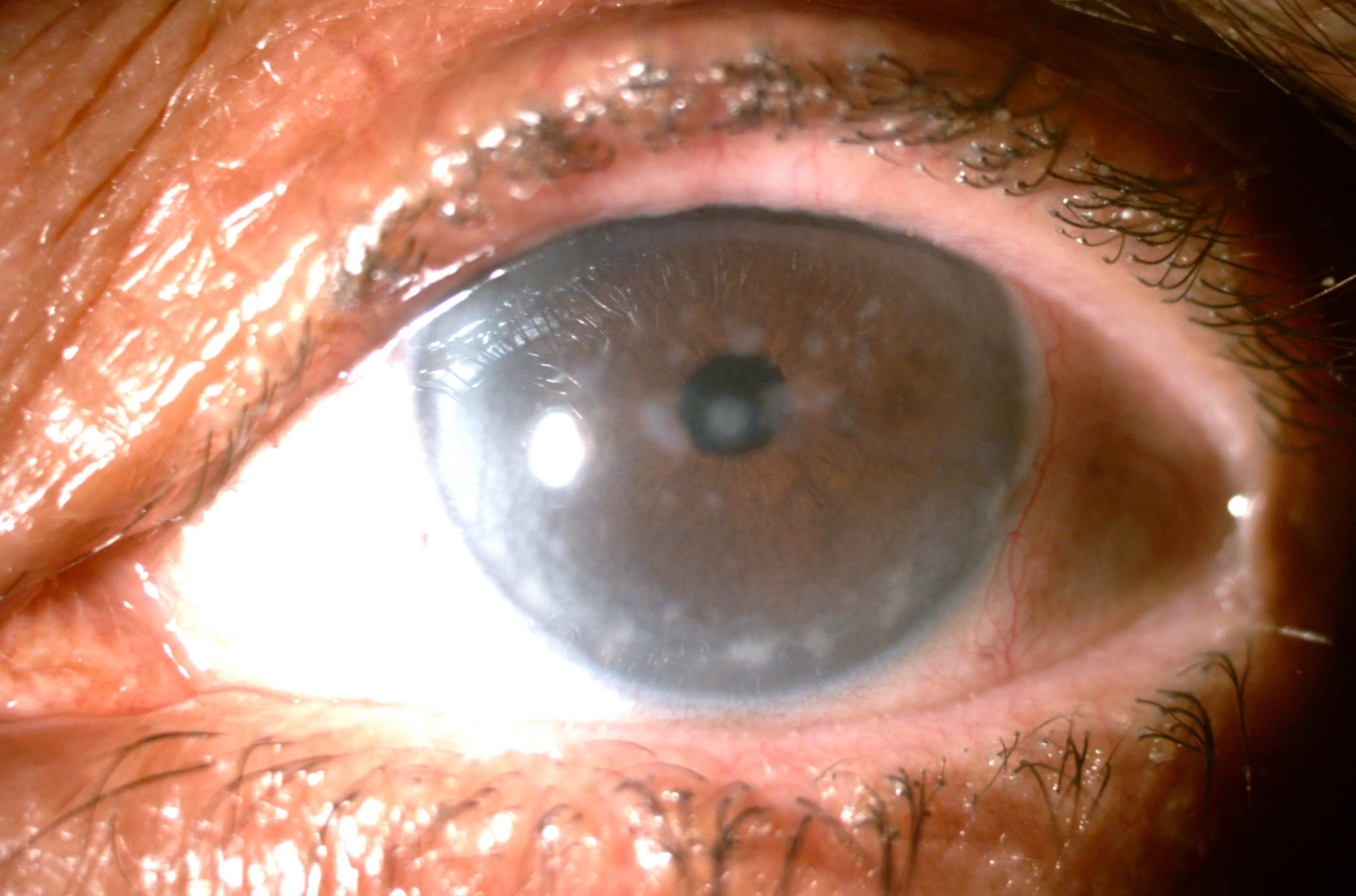 Corneal Dystrophy