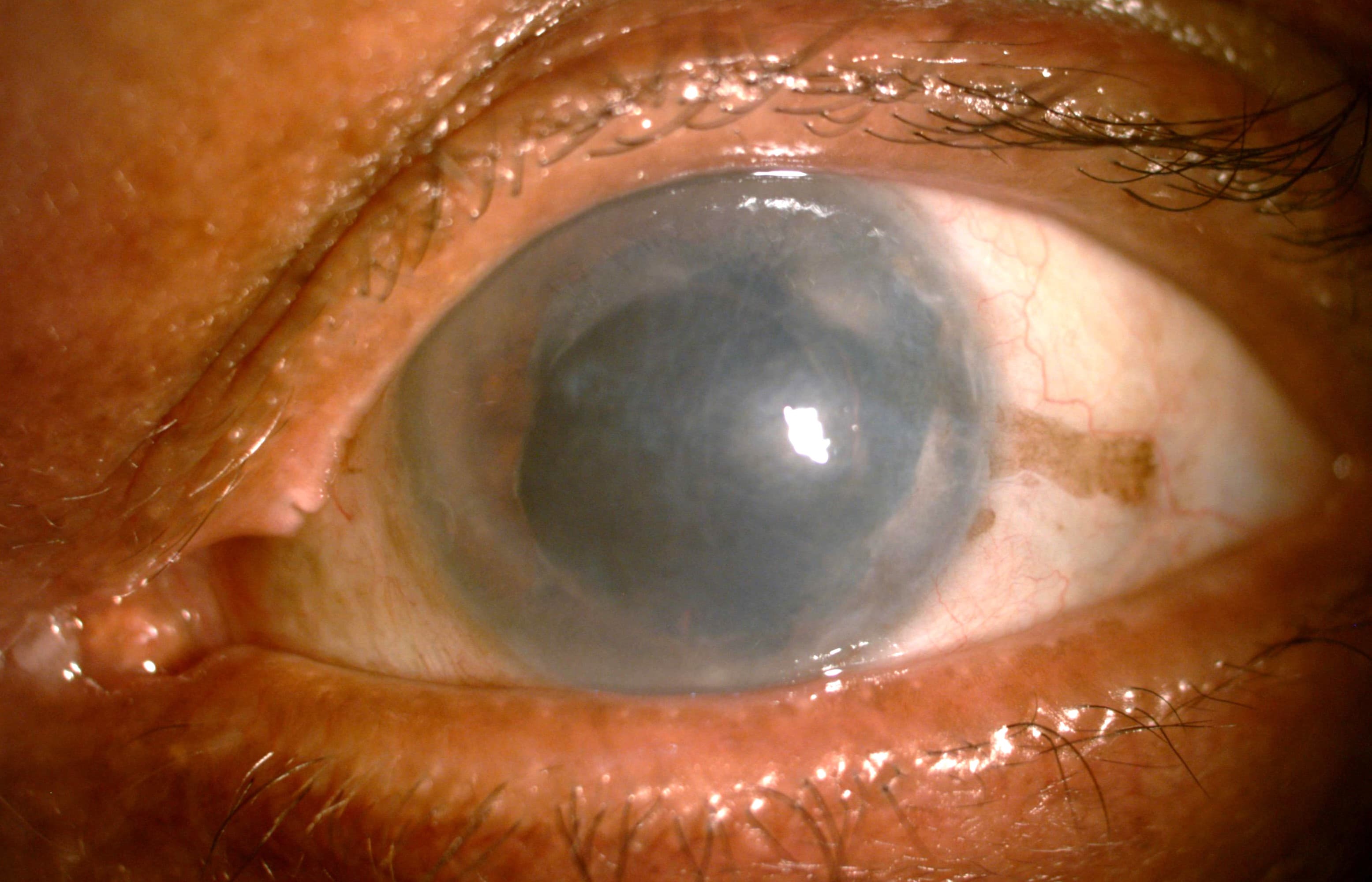 Corneal Oedema