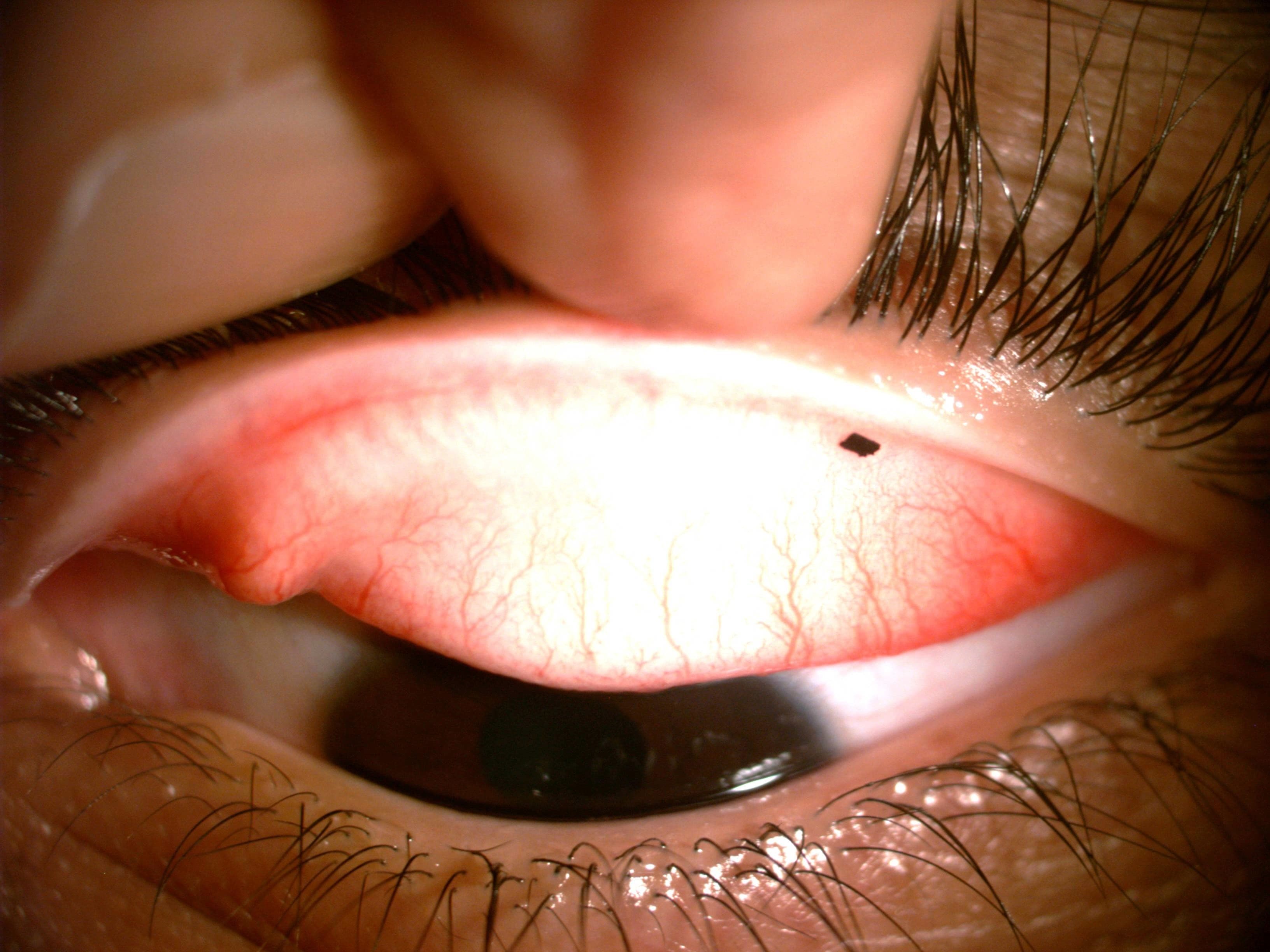 Foreign Body — Tarsal Conjunctiva
