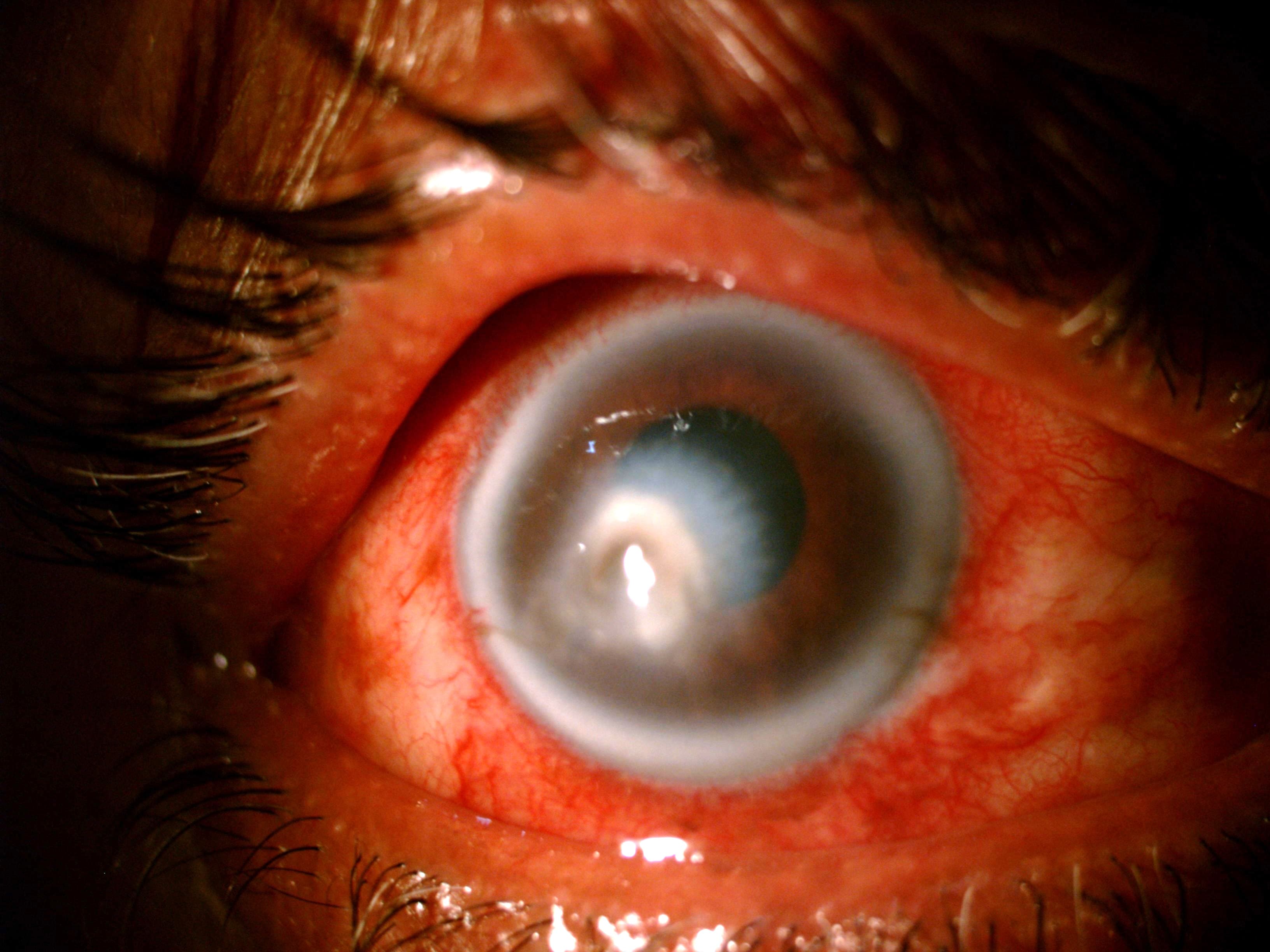 Fungal Corneal Ulcer