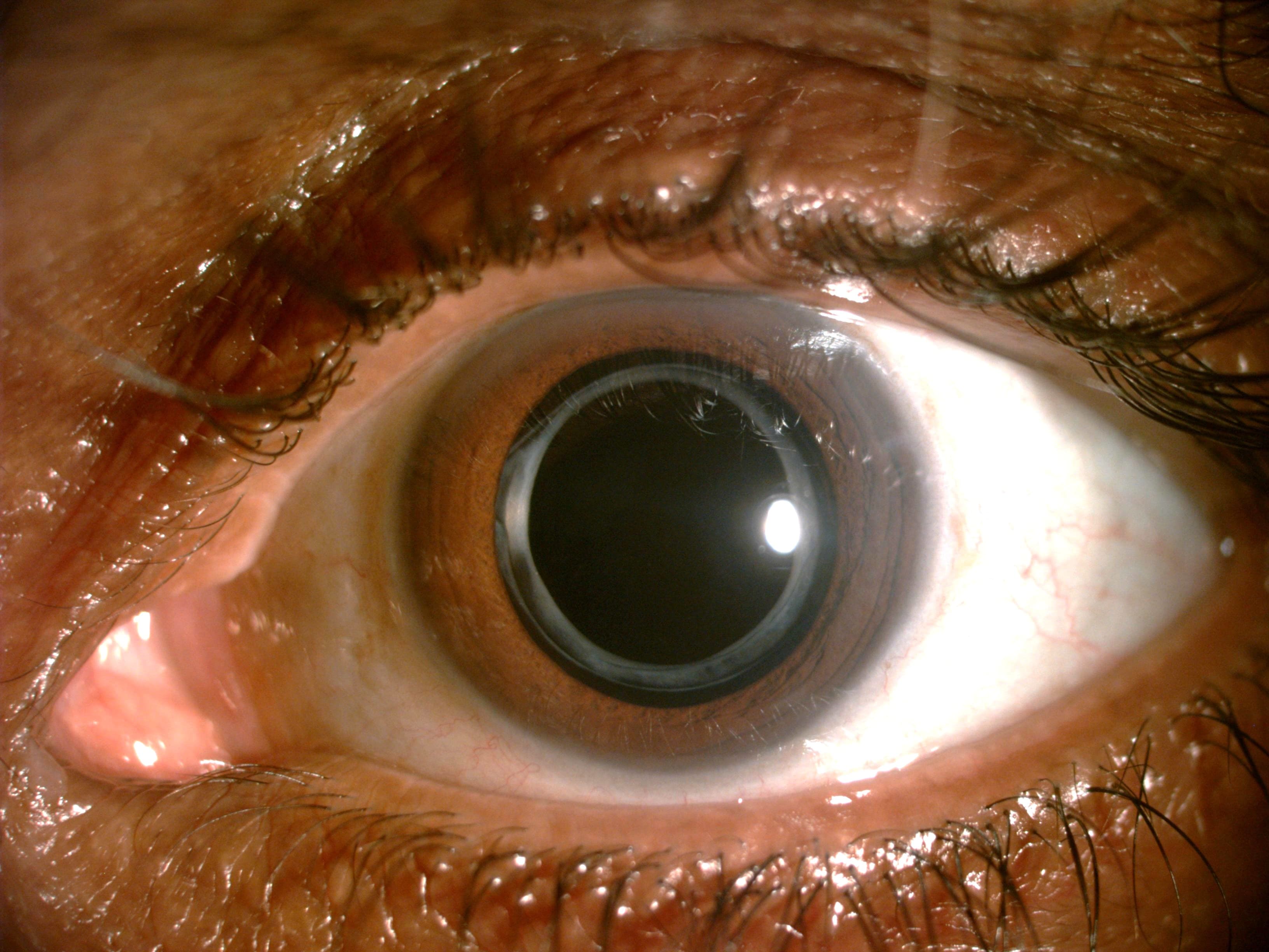 IOL with Anterior Capsule Thickening