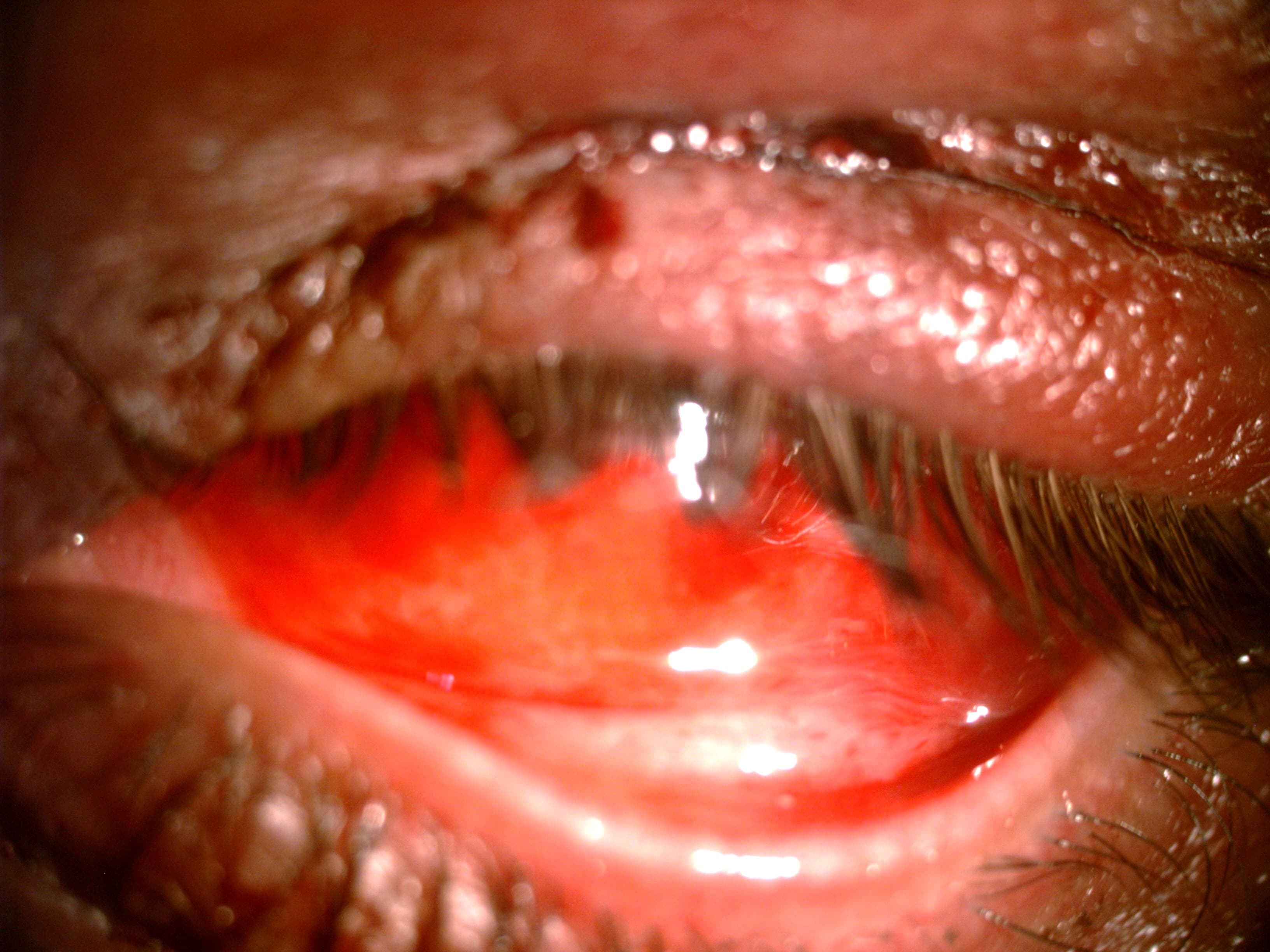 Lid Laceration & Subconjunctival Haemorrhage