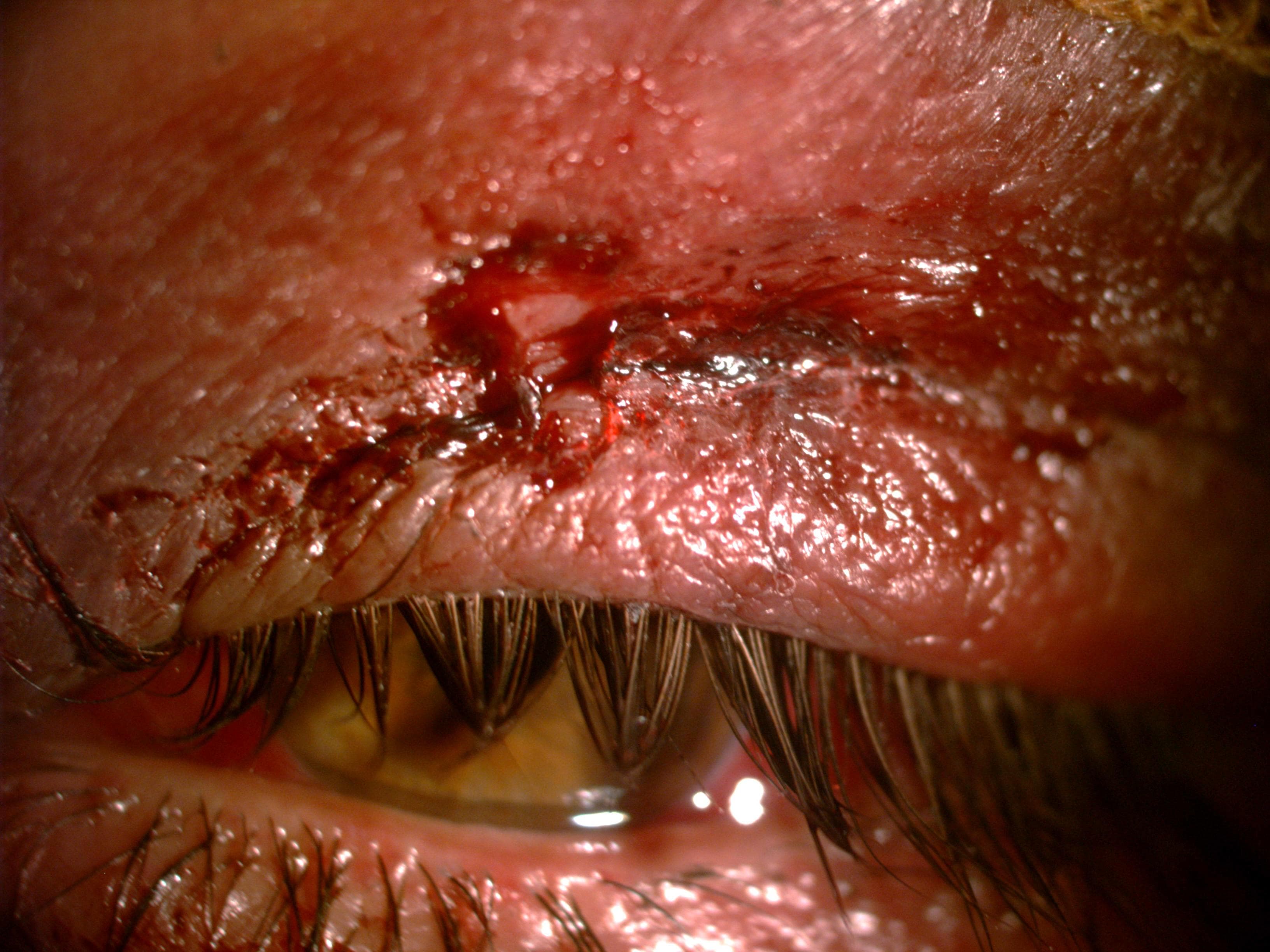Lid Trauma