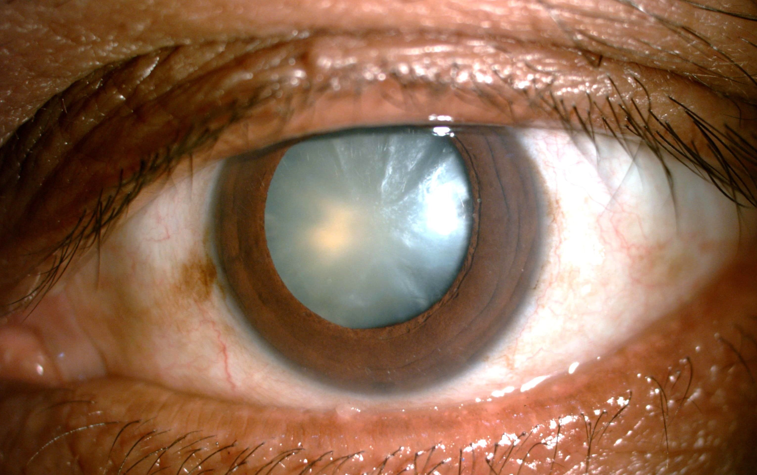 Mature Cataract
