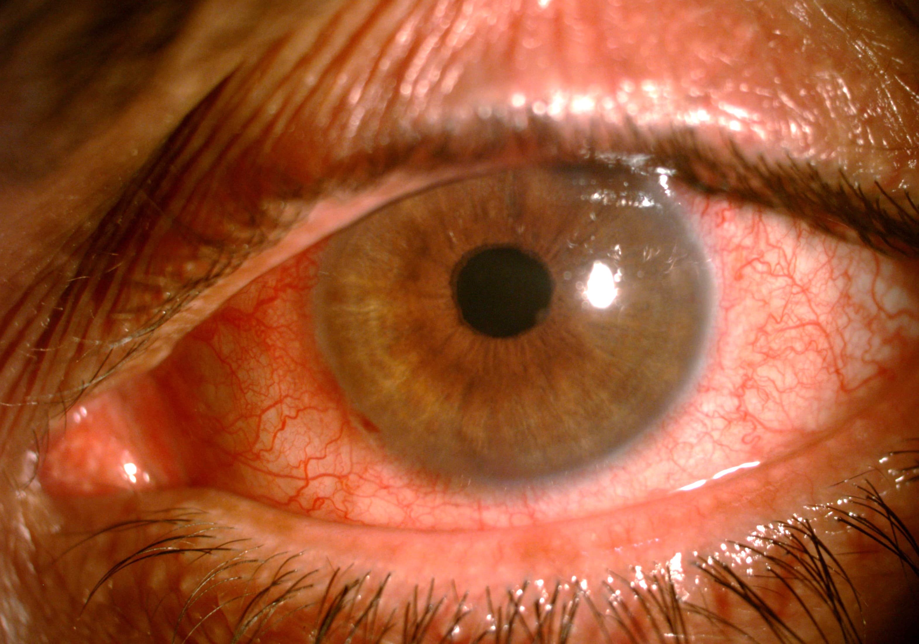Pink Eye