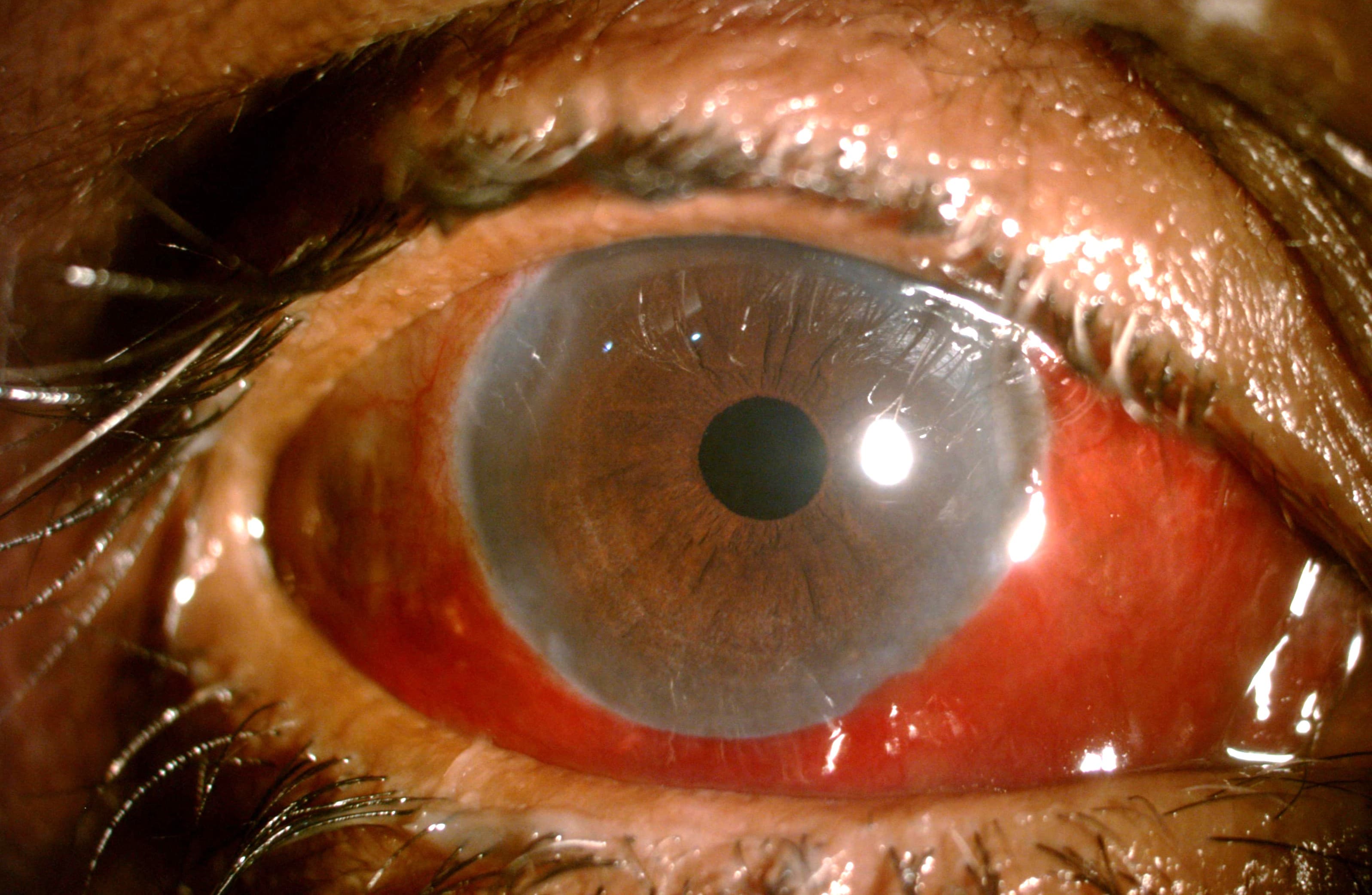 Subconjunctival Haemorrhage