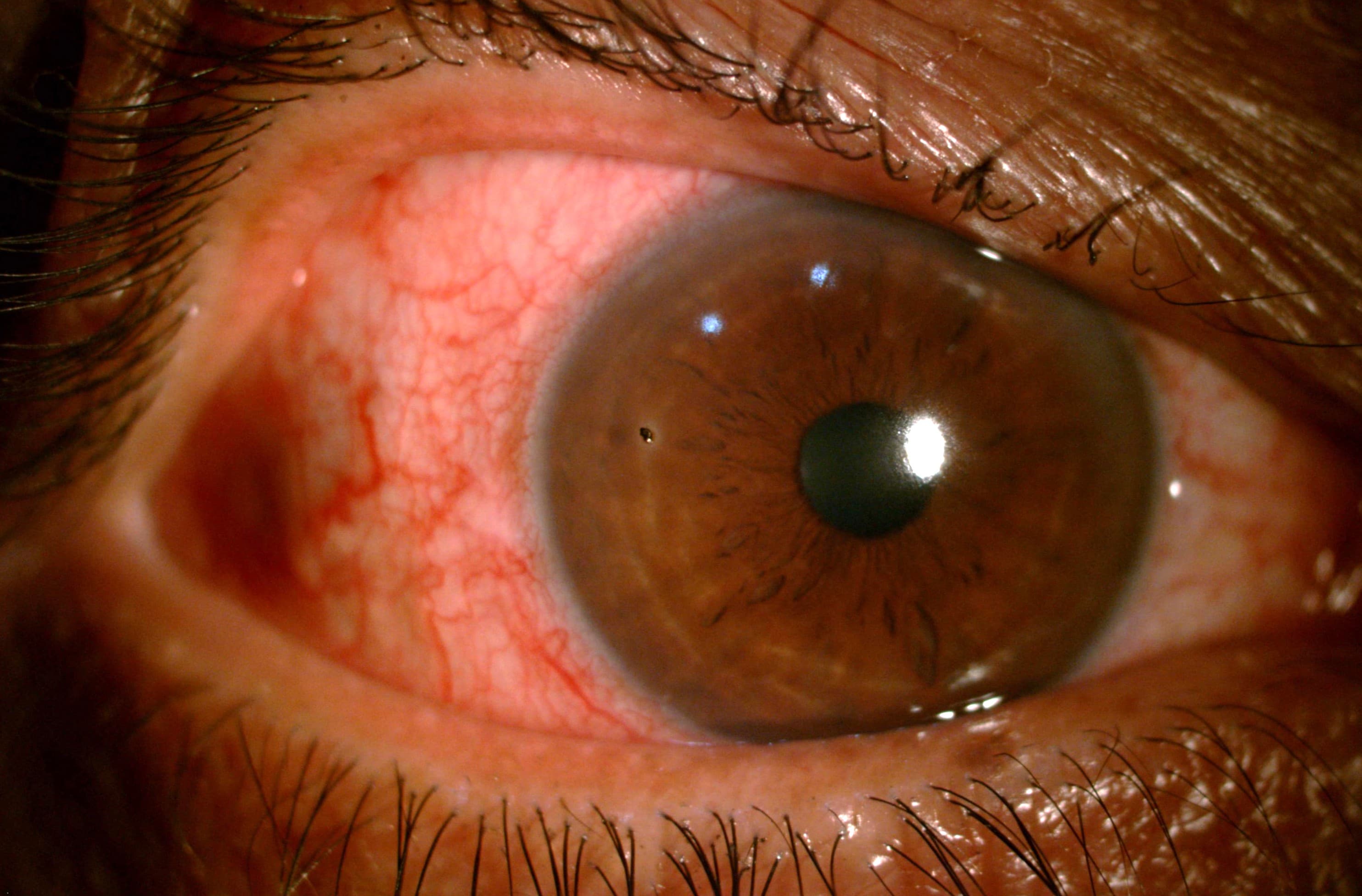 Corneal Foreign Body